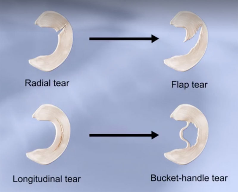 meniscus tears in knee sport injuries Mr Aslam Mohammed extensive experience in treating knee sports injuries meniscus tears 